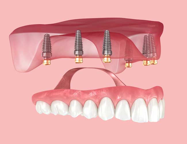 Implant Dentures
