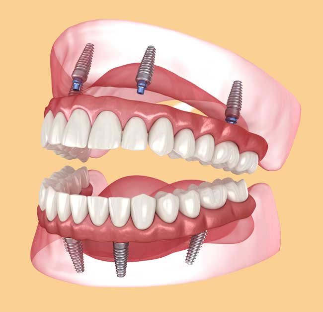 Implant Dentures